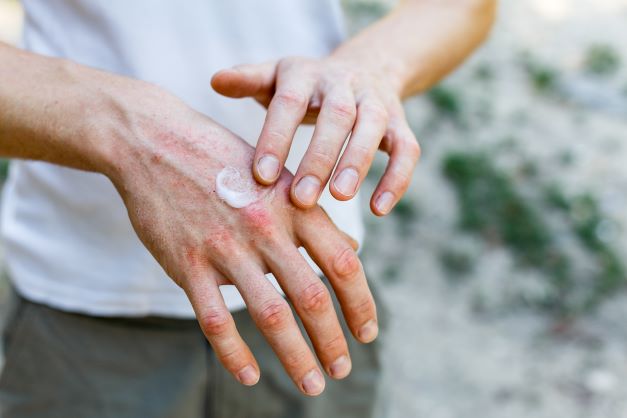 How Common Is Eczema? We Explain What It Is and How to Identify It